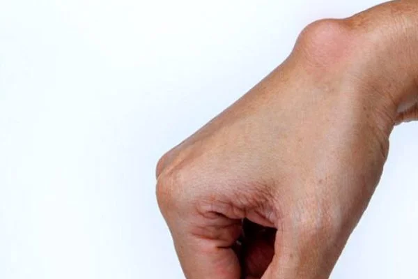 Cysts & Soft Tissue Masses